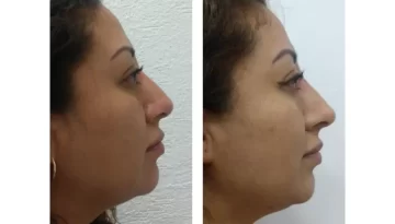 medesthetic-rinomodelacion-casoclinico-1358-2