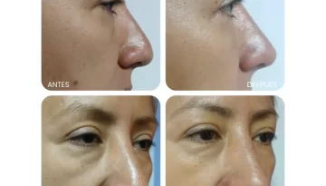 medesthetic-rinomodelacion-casoclinico-2100