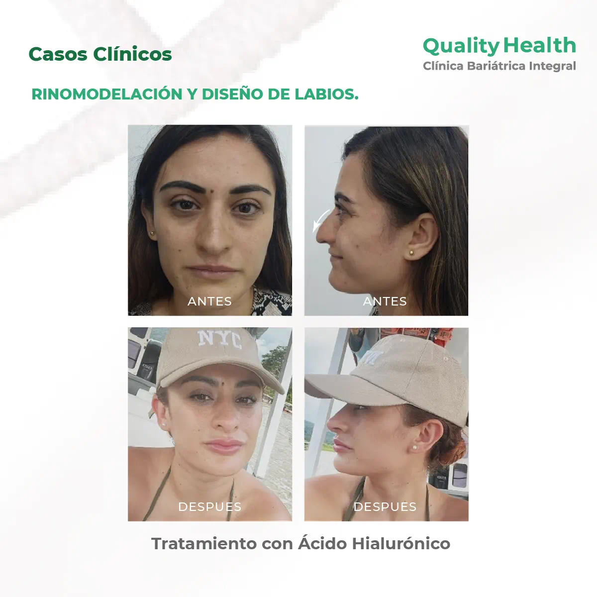 caso-clinico-rnimodelacion-diseno-de-labios-acidohialuronico