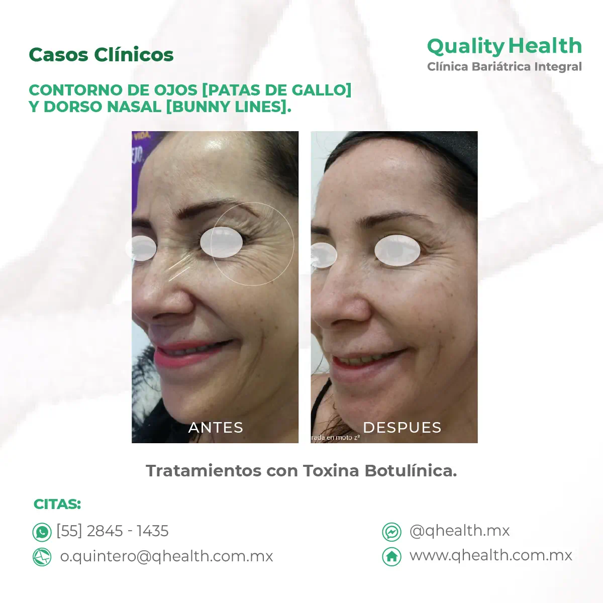 caso-clinico-rodete-surco-pretarsal-contorno-de-ojos-toxina-botulinica