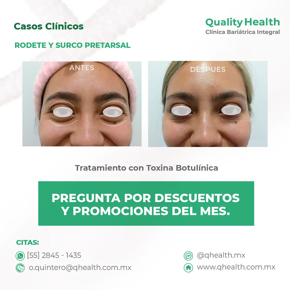 caso-clinico-rodete-y-surco-pretarsal-toxina-botulinica